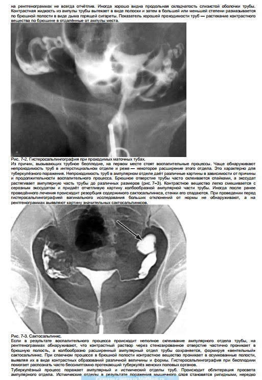 Спайки труб форум. Непроходимость маточных труб УЗИ. Непроходимые маточные трубы. Маточные трубы облитерированы что это такое. Непроходимость труб у женщин.